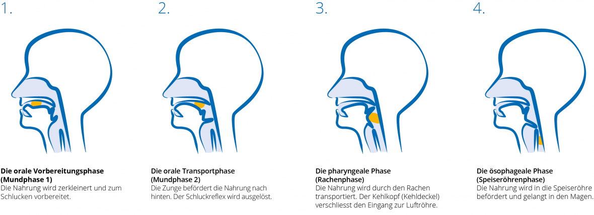 Eine Darstellung der vier Phasen des Schluckens: 1.Orale Vorbereitungsphase (Mundphase 1): Die Nahrung wird zerkleinert und zum Schlucken vorbereitet. 2.Orale Transportphase (Mundphase 2): Die Zunge befördert die Nahrung nach hinten. Der Schluckreflex wird ausgelöst. 3.Pharygeale Phase (Rachenphase): Die Nahrung wird durch den Rachen transportiert. Der Kehlkopf verschließt den Eingang zur Luftröhre. 4.Ösophageale Phase (Speiseröhrenphase): Die Nahrung wird in die Speiseröhre und in den Magen befördert. 
