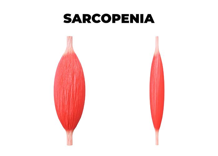 sarcopenia